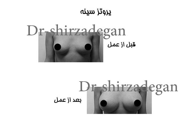 نمونه کار جراحی سینه پروتزی